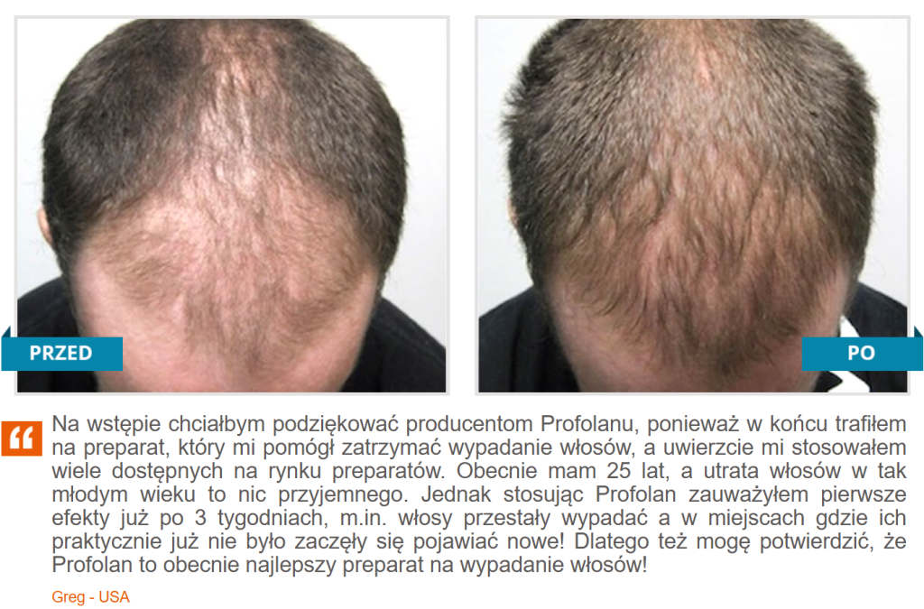 Profolan - na łysienie, wypadanie włosów, wzmocnienie włosów, stymulacja wzrostu nowych włosów, redukcja łysienia androgenowego, formuła Grow3, biotyna, miedź, witamina E, tauryna