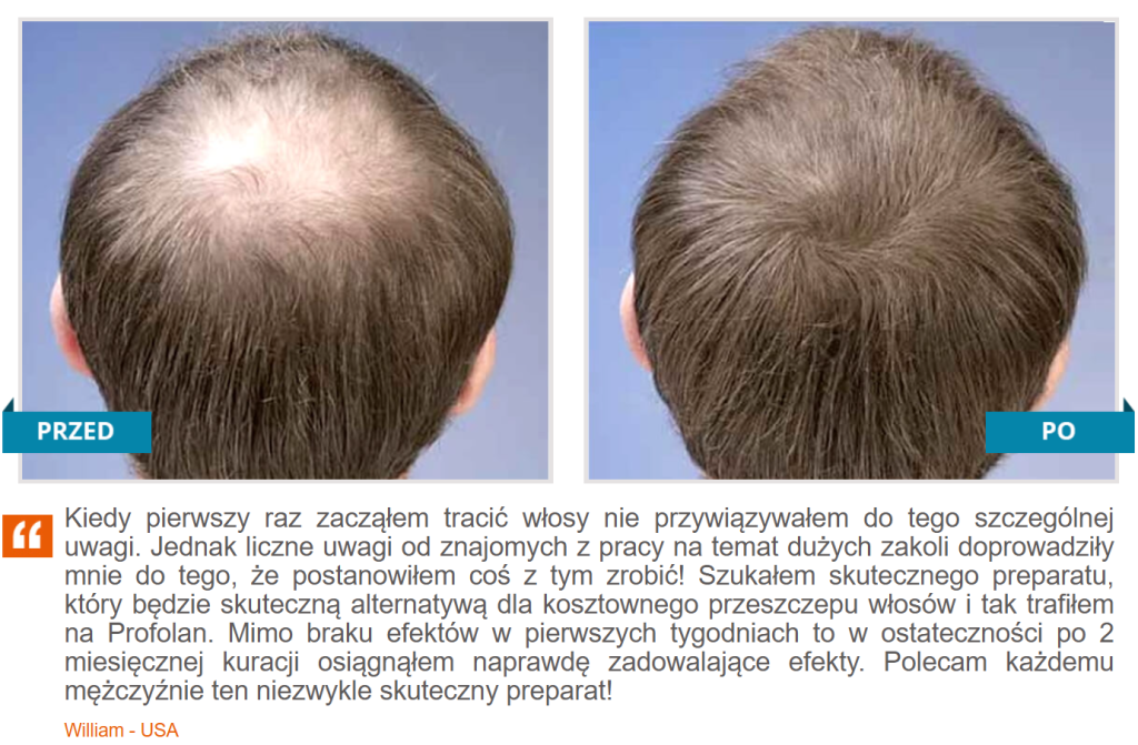 Profolan - na łysienie, wypadanie włosów, wzmocnienie włosów, stymulacja wzrostu nowych włosów, redukcja łysienia androgenowego, formuła Grow3, biotyna, miedź, witamina E, tauryna
